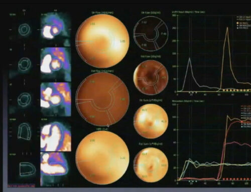 Identifying potential in-stent restenosis with new onset of chest pain with N-13 Ammonia Cardiac PET/CT